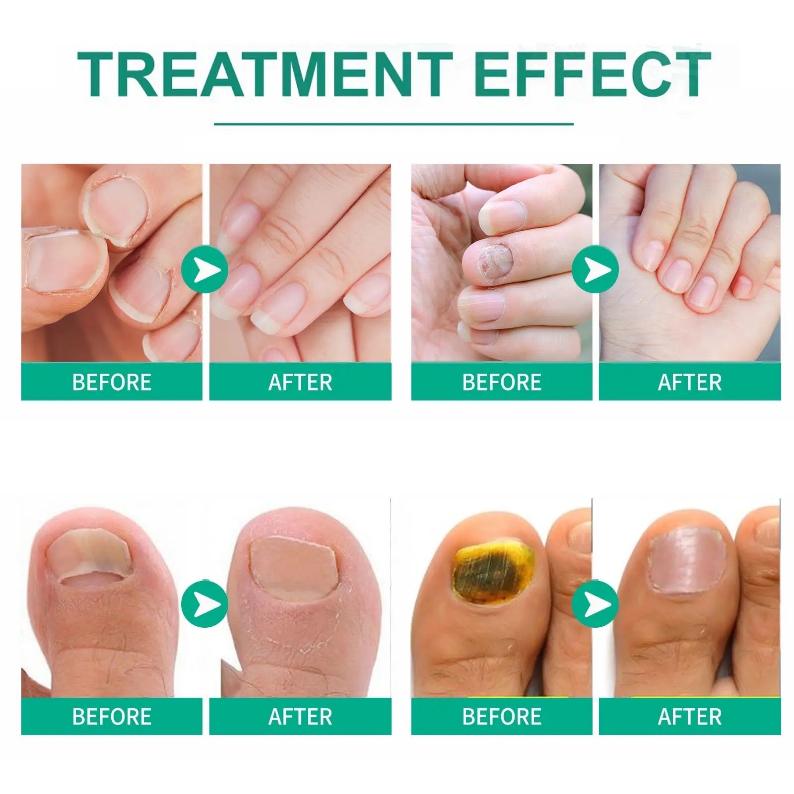 Nail Fungus Solution, Anti Infection Nail Fungus Removal Gel, Ingrown Toenail Treatment Nail Care Oil, Nail Fungus Treatments Serum Nail Fungus Solution, Anti Infection Nail Fungus Removal Gel, Ingrown Toenail Treatment Nail Care Oil, Nail Fungus Treatments Serum